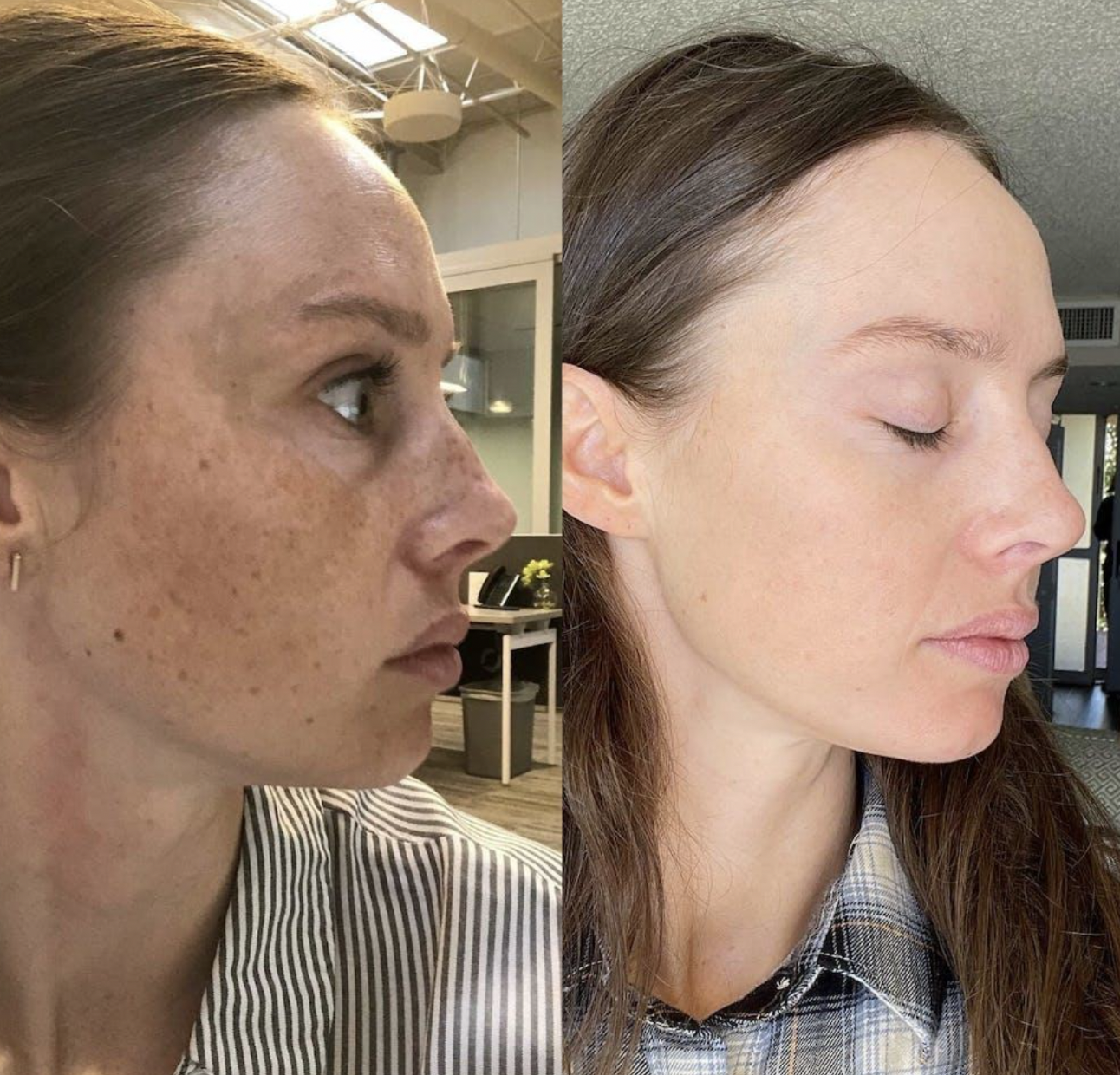Woman after LED Light Therapy Treatment